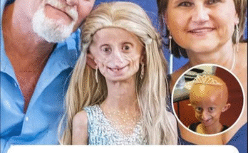 Beandri Booysen, South African Teen with Progeria, Dies at 19
